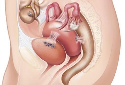Endometriosis